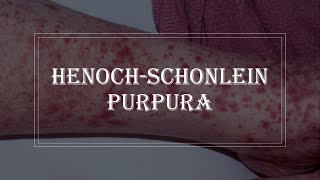 HenochSchonlein Purpura  purple rash on skin vasculitis [upl. by Trella]