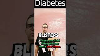 Blister on Foot Toe or Between Toes Diabetic Skin Symptoms [upl. by Nikaniki777]