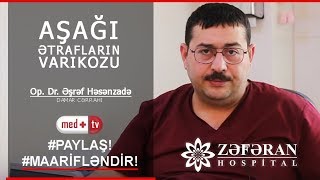 Varikoz  Op Dr Esref Hesenzade Damar cerrahi Zeferan Hospital  Medplus TV [upl. by Teragram]