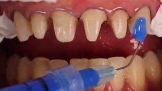 Adhesive cementation of ceramic veneers [upl. by Fernandes]