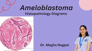 Ameloblastoma  Histopathology  Easiest Diagrams  Oral Pathology BDS [upl. by Acirre]