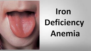 Iron Deficiency Anemia [upl. by Egidio]