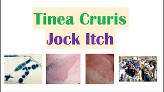 Jock Itch Tinea Cruris  Causes Risk Factors Signs amp Symptoms Diagnosis and Treatment [upl. by Aveer]