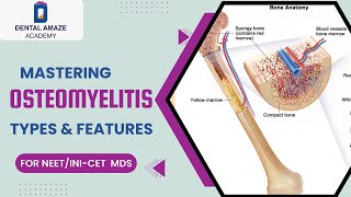 Mastering Osteomyelitis Types amp Features For NEETINICET MDS [upl. by Leahpar]