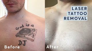 Laser Tattoo Removal  Before and After through all the stages [upl. by Latouche]