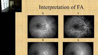 Fluorescein Angiography Dr Mahmood Mekkawy [upl. by Renner]