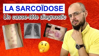 La SARCOÏDOSE  Une maladie digne dun épisode de Dr HOUSE [upl. by Evelyn]