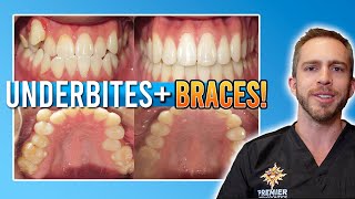 Underbite Braces Treatment W Rubber Bands BEFORE amp AFTER [upl. by Noirda]