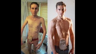 My Survival Story  Living With An Ileostomy Bag [upl. by Mosenthal]