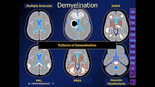 ⚕️ Making Sense of White Matter Disease by James G Smirniotopoulos MD [upl. by Pedroza771]