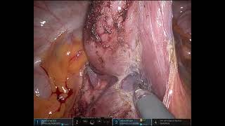 Robotic D J anastomosis for superior mesenteric artery syndrome [upl. by Ariait]