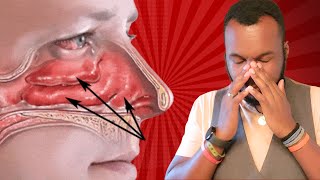 Eustachian Tube Dysfunction Unclog your ear instantly [upl. by Aziram373]