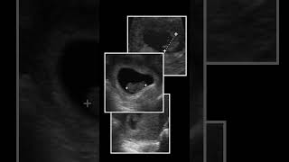 Ultrasound Progression of the 1st Trimester pocus ultrasound [upl. by Chester]