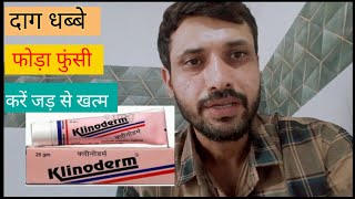 दाग धब्बे फोड़े फुंसियों के लिए आयुर्वेदिक इलाज klinoderm cream review [upl. by Luapnaes635]