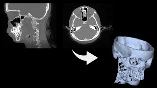 Work In Progress CT Scan DICOM to 3D Mesh STL conversion [upl. by Mart]