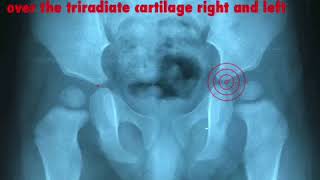 Acetabular Index measurement by the AI app [upl. by Stutman169]