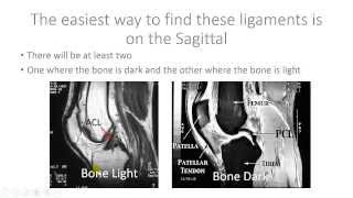 Read Knee MRI ACL and PCL  Help with Reading MRI [upl. by Thomsen]