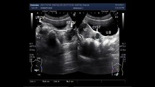 Ultrasound Video showing a Cervical Cyst [upl. by Lavina]