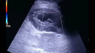 Case of postmenopausal bleeding [upl. by Estrellita550]