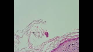 Histopathology of Lupus erythematosus [upl. by Burkhardt877]