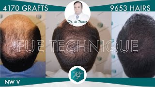 Injerto Capilar Técnica FUE – 4170 Grafts 9653 Pelos – Dr Rafael de Freitas [upl. by Aneehsar]