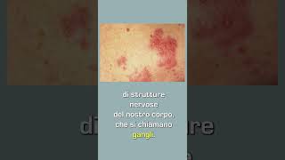 Nevralgia posterpetica e quotfuoco di SanAntonioquot Dott Antonio Musio neurochirurgo herpeszoster [upl. by Purse]