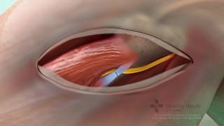 Common Peroneal Nerve Decompression  Single Cell Animation [upl. by Lilia]