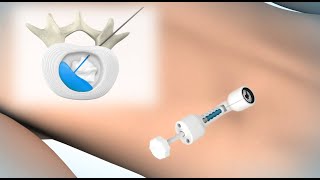 ReGelTec HYDRAFIL™ System [upl. by Acinorrev]