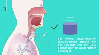 Subglottische Absaugung einer Trachealkanüle  Animation  Andreas Fahl MedizintechnikVertrieb GmbH [upl. by Zilevi766]