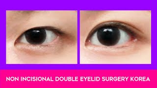 Non Incisional Double Eyelid Surgery Korea [upl. by Eyahsal31]