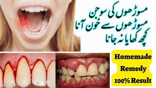 Gum Swelling Treatment  Masudo me sujan aur dard ka ilaj  Homemade Remedy  Saira Kanwal [upl. by Yenffit]