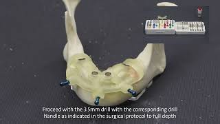 Straumann® Guided Surgery System and Straumann® BLT [upl. by Michon]