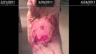 2nd Degree burns on foot  healing time lapse  2 months [upl. by Bliss]