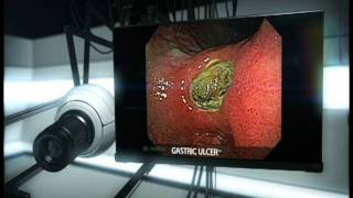 Gastric Ulcer [upl. by Elena195]