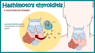 Hashimotos thyroiditis  Autoimmune diseases [upl. by Blunt]