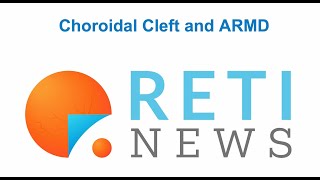 Choroidal Cleft and nARMD activity [upl. by Nemlaz]