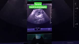 ventriculomegaly ultrasound usg pregnancy anomaly [upl. by Najar]