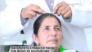 Tratamiento a paralisis facial por medio de acunpuntura [upl. by Nnaecarg]