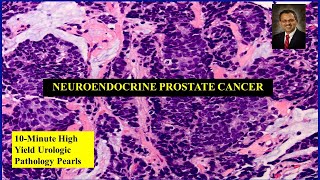 Neuroendocrine prostate cancer [upl. by Esiled118]