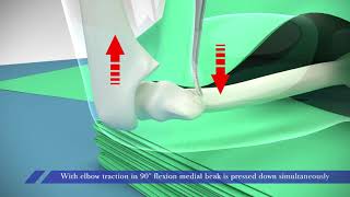 Supracondylar Fracture in ChildrenPercutaneous reduction technique [upl. by Niuqaoj]