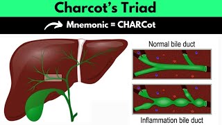 Charcot’s Triad Mnemonic  Charcot’s Triad For Ascending Cholangitis Mnemonic  Dr Mubashar Ata [upl. by Notse141]