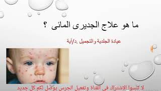 📝 روشتة علاج الجديدى المائى  وازاى تحمى اطفالك من الجديرى ؟ chicken pox [upl. by Engedus]