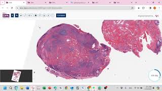 Epithelioid hemangioma aka angiolympoid hyperplasia with eosinophilALHE [upl. by Pahl]