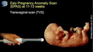 The 12 week scan transabdominal and transvaginal ultrasound [upl. by Cindra]