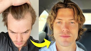 My Turkey Hair Transplant Results After 1 Year  Before amp After [upl. by Fidelia]