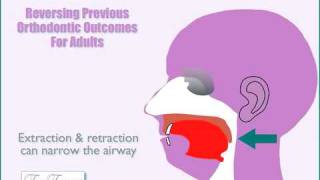 Can extractions headgear orthodontic appliances andor braces impact your airway amp breathing [upl. by Blackwell6]