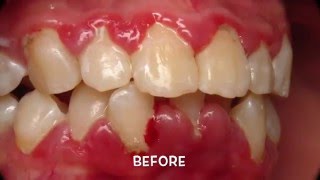 Treatment of Periodontal Gum Disease [upl. by Ahsitneuq]