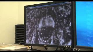 Prostate Biopsy Targeted Biopsy Using MRUltrasound Fusion [upl. by Niamreg355]