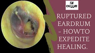 Ruptured eardrum I what should you do after traumatic perforation of tympanic membrane [upl. by Andersen]