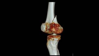 Femur medial condyle fracture [upl. by Sherrod]